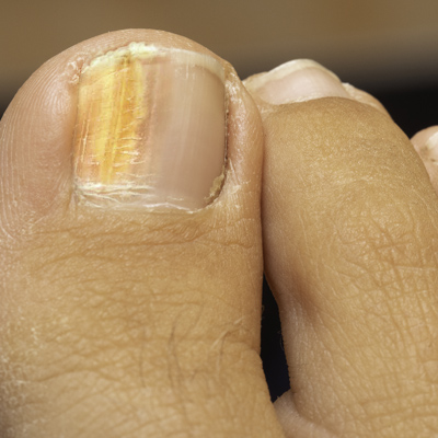 Mobile podiatrist in Falkirk and Scotland toenail fungal infection yellow and brittle thick looking nail