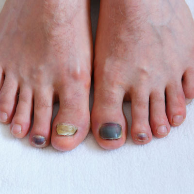 Mobile podiatrist in Falkirk and Scotland fungal toenails on male foot