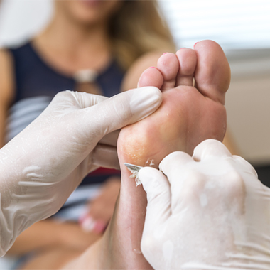 Mobile podiatrist in Falkirk and Scotland skin problems and calluses being removed from lady's foot by podiatrist