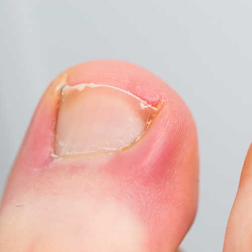 Mobile podiatrist in Falkirk and Scotland ingrown and inflamed toenail